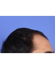 Before Hair Transplant&nbsp;Front